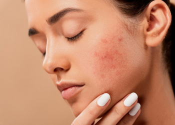 ¿Cómo evitar el acné?